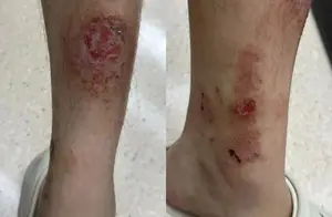 和女友游西湖后惊险遭遇：男子双腿为何溃烂？